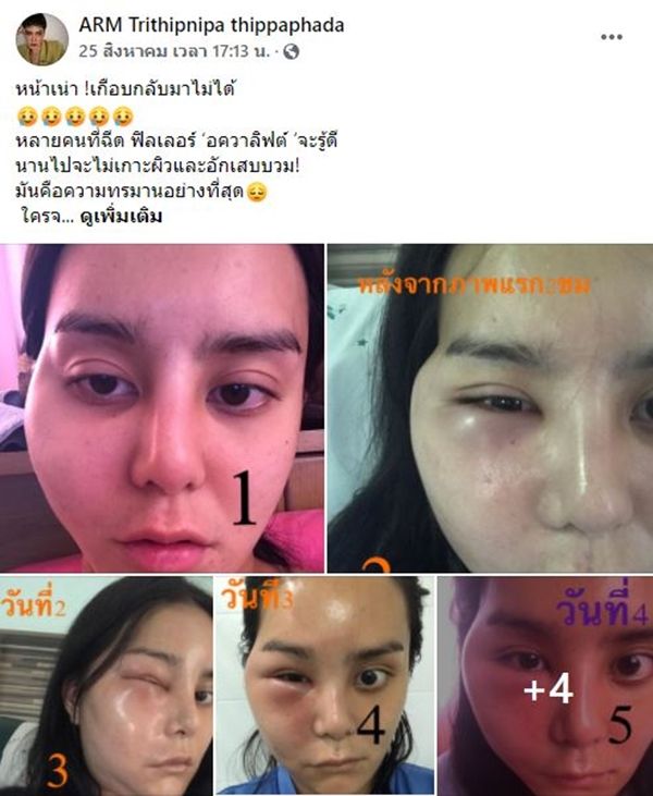 พิษศัลยกรรม! อาร์ม มิสทรานยูนิเวิร์สไทยแลนด์ หน้าบวมหวิดเน่า