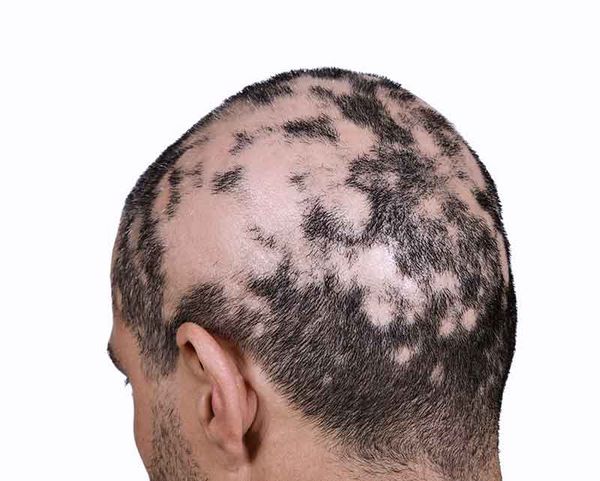 รู้จักโรคผมร่วงเป็นหย่อม (Alopecia) ภาวะร้ายที่ภรรยาของ วิลล์ สมิธ ต้องเผชิญ