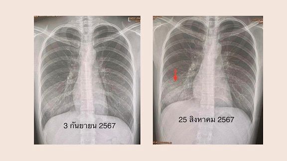 ปอดเป็นฝ้าขาว ติดเชื้อไมโคพลาสมา ยังไม่มีวัคซีนป้องกัน เช็กสัญญาณอาการ ?