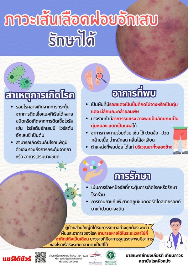 รู้จัก เส้นเลือดฝอยอักเสบ สาเหตุเกิดจากอะไร ลักษณะรอยโรคเป็นอย่างไร?