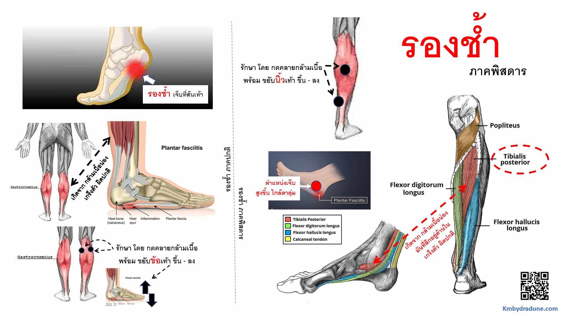 หมอศิริราชเผยพบโรค รองช้ำ แบบภาคพิศดาร แนะวิธีแก้ให้ถูกจุด