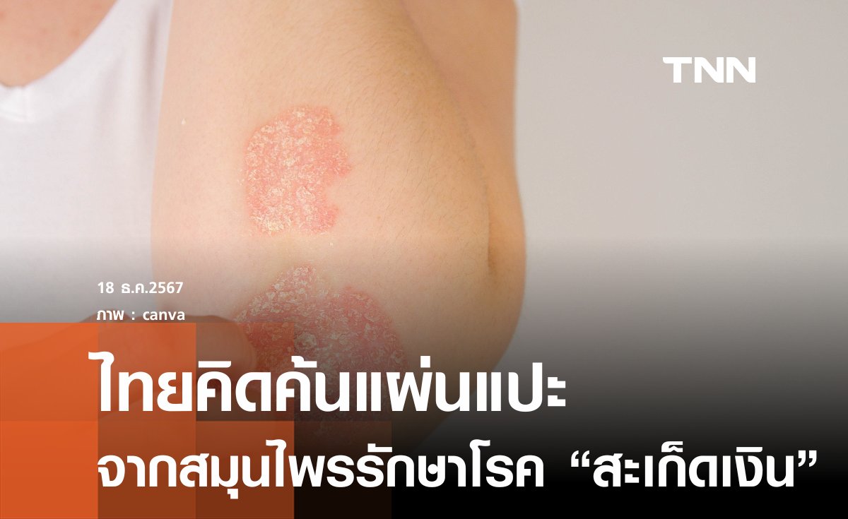 นักวิจัยไทยคิดค้น นวัตกรรมแผ่นแปะสำหรับผู้ป่วย “โรคสะเก็ดเงิน”  