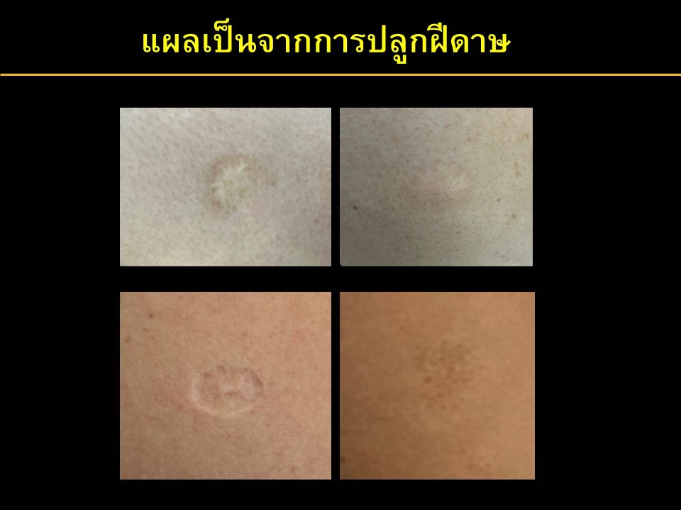 หมอยงไขข้อสงสัย ไทยเลิก “ปลูกฝี” เมื่อใด?