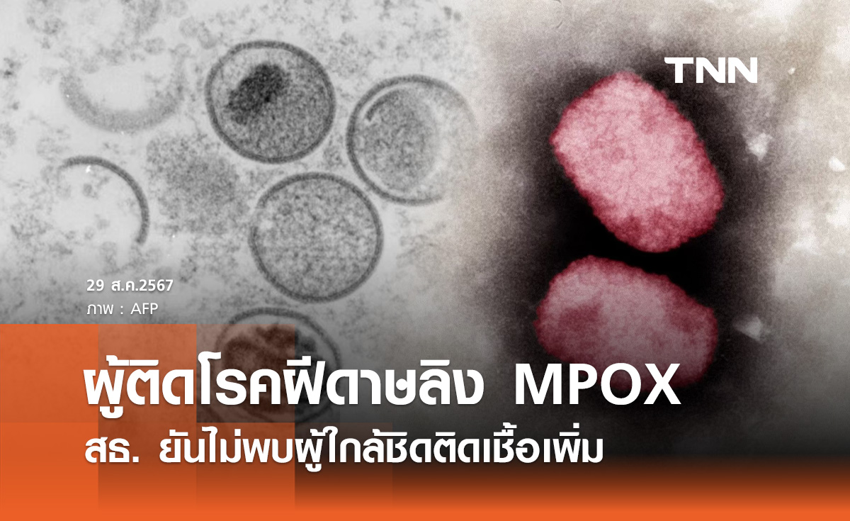 ฝีดาษลิง (MPOX) กรมควบคุมโรค ยันไม่พบผู้ใกล้ชิดติดเชื้อเพิ่ม