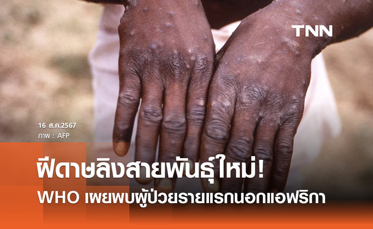 ฝีดาษลิงสายพันธุ์ใหม่! WHO ยืนยันพบผู้ติดเชื้อรายแรกนอกแอฟริกา