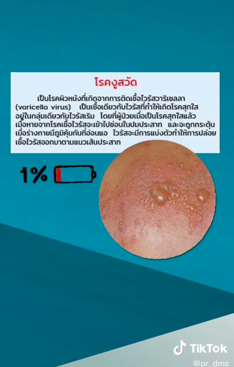 โหมงานหนัก-พักผ่อนน้อยพึงระวัง! เสี่ยงเกิดโรคงูสวัด โหมงานหนัก-พักผ่อนน้อยพึงระวัง! เสี่ยงเกิดโรคงูสวัด