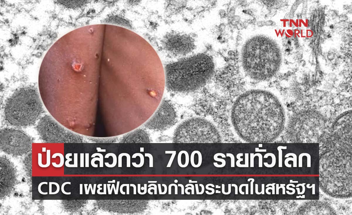 ฝีดาษลิงระบาด! CDC เผยพบผู้ป่วยแล้วกว่า 700 รายทั่วโลก