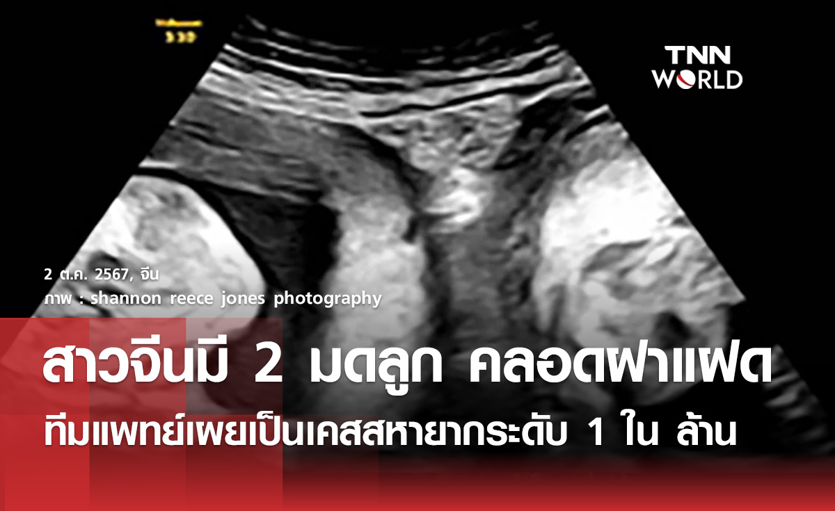 สาวจีนมี 2 มดลูก แต่สามารถให้กำเนิด “เด็กแฝด”