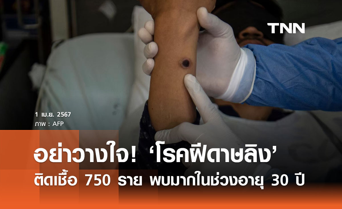 อย่าเพิ่งวางใจ! ‘โรคฝีดาษลิง’ พบผู้ติดเชื้อแล้ว 750 ราย ช่วงอายุ 30 มากสุด