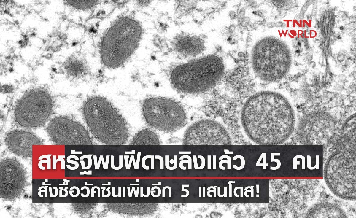 สหรัฐฯสั่งซื้อวัคซีน "ฝีดาษลิง" เพิ่ม 5 แสนโดสพบผู้ติดเชื้อแล้ว 45 คน