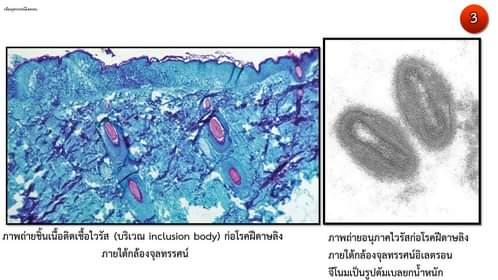 โรคฝีดาษลิง กลายพันธุ์เร็วขึ้น! ศูนย์จีโนมฯ เปิดผลวิจัยชี้ 4 ปี กลายพันธุ์ 40 ตำแหน่ง