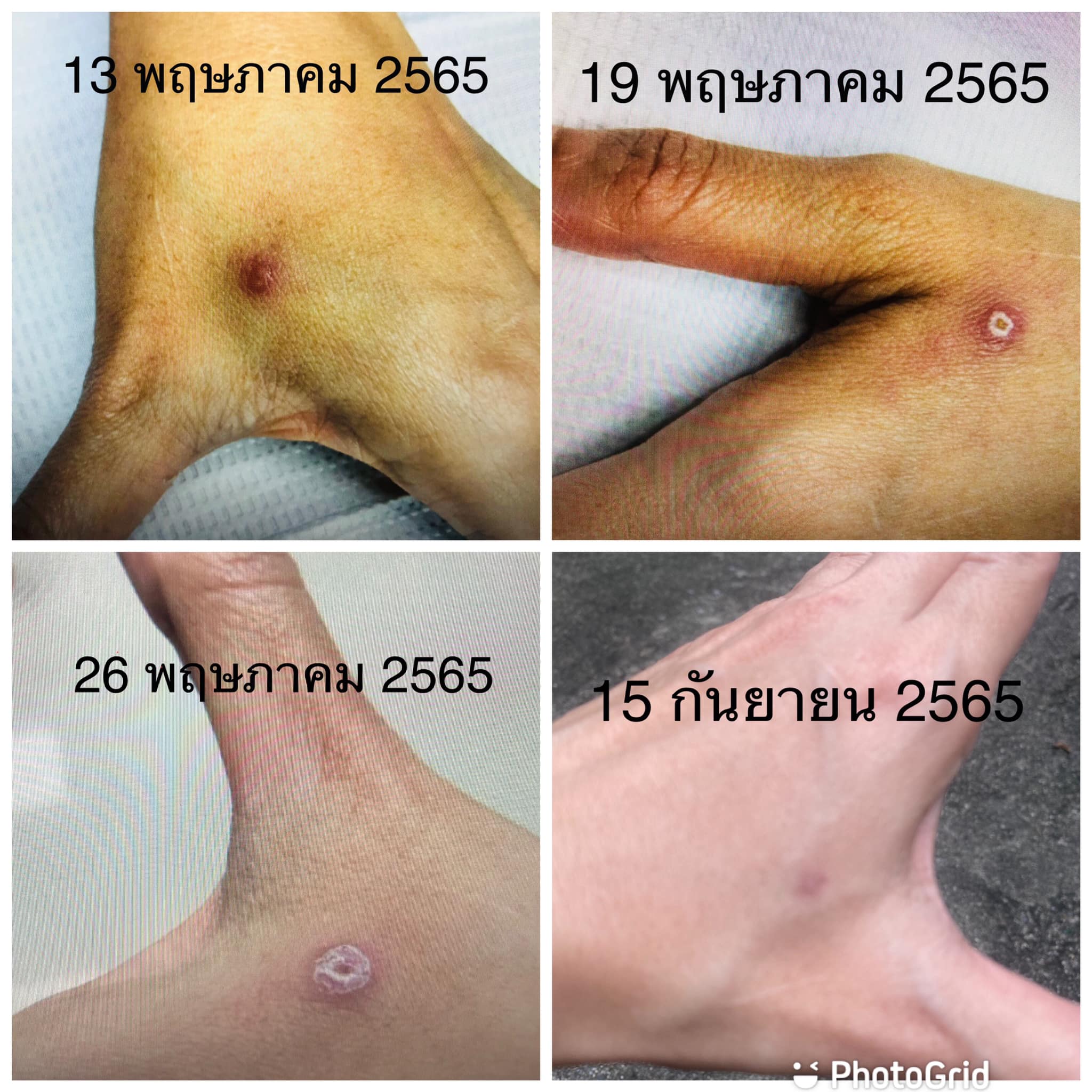 เลี้ยงแมวต้องระวัง! ถูกกัด-ข่วนเสี่ยงเป็น ‘โรคสปอโรทริโคซิส ’