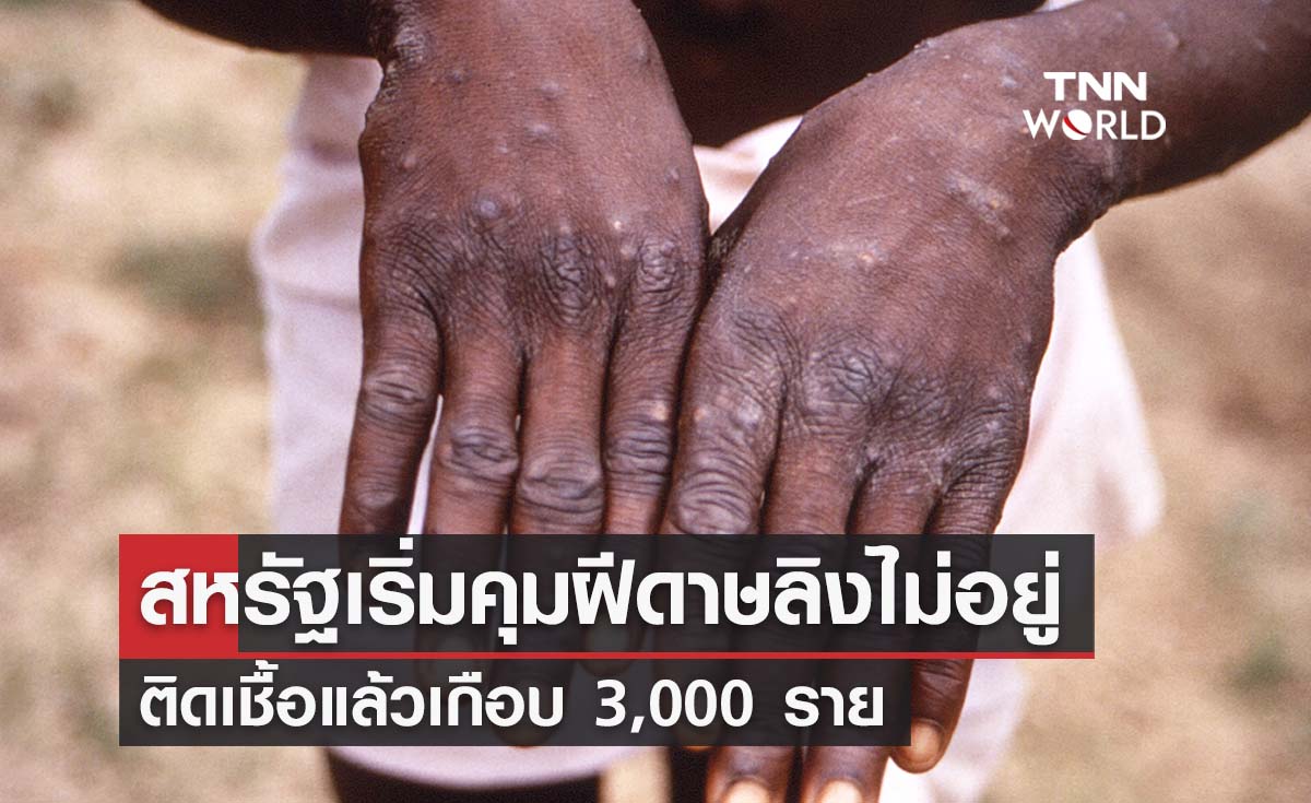 ฝีดาษลิง สหรัฐอาการเริ่มหนัก ติดเชื้อแล้วเกือบ 3,000 ราย