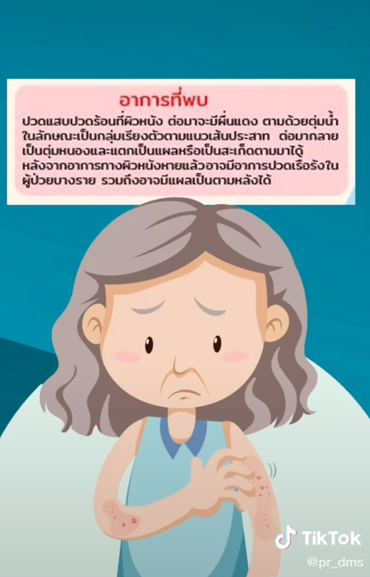 โหมงานหนัก-พักผ่อนน้อยพึงระวัง! เสี่ยงเกิดโรคงูสวัด โหมงานหนัก-พักผ่อนน้อยพึงระวัง! เสี่ยงเกิดโรคงูสวัด