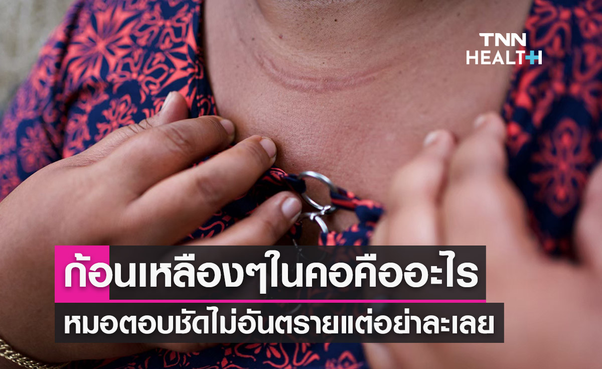 ก้อนเหลืองๆในคอ เกิดจากอะไร-หมอตอบชัดไม่อันตรายแต่อย่าละเลย