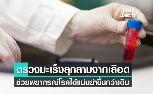 นักวิจัยอังกฤษ คิดค้นวิธีตรวจหา มะเร็งระยะลุกลาม จากเลือด 