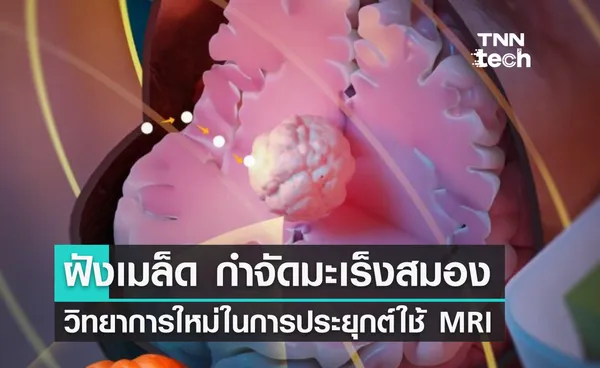 เทคโนโลยีใหม่ !! ฝังเมล็ดแม่เหล็ก - กำจัดมะเร็งสมอง ด้วย MRI