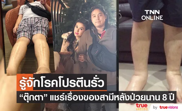 รู้จักโรคโปรตีนรั่ว ตุ๊กตา แชร์ประสบการณ์ของสามี ตัวบวมน้ำหนักขึ้นเกือบ 100 กิโล!!