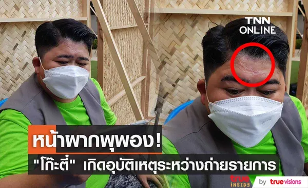 โก๊ะตี๋ เกิดอุบัติเหตุ หน้าผากพุพอง จากโดนฝาซึ้งร้อน ๆขณะถ่ายรายการ (มีคลิป)