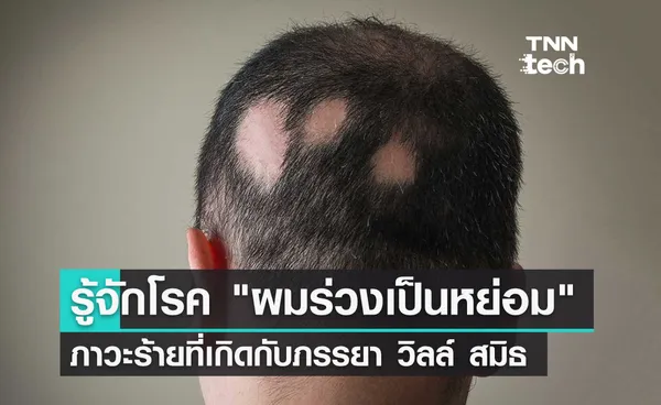 รู้จักโรคผมร่วงเป็นหย่อม (Alopecia) ภาวะร้ายที่ภรรยาของ วิลล์ สมิธ ต้องเผชิญ