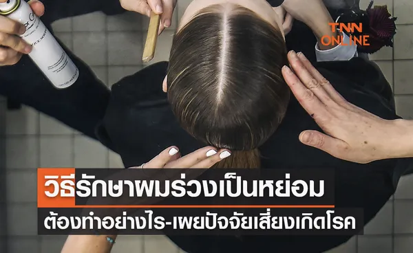 เปิดวิธีรักษา “โรคผมร่วงเป็นหย่อม” ต้องทำอย่างไร