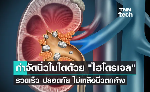 กำจัดนิ่วในไตด้วย ไฮโดรเจล รวดเร็วปลอดภัย ไม่เหลือนิ่วตกค้าง