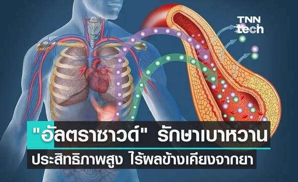 รักษาเบาหวานด้วย อัลตราซาวด์ ประสิทธิภาพสูง ไร้ผลข้างเคียงจากการใช้ยา 