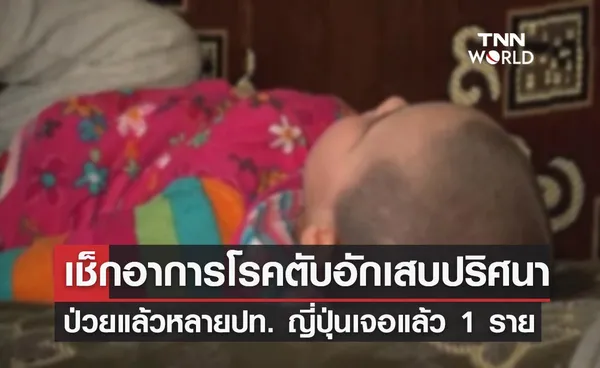 เช็กอาการ โรคตับอักเสบปริศนา ล่าสุดเจอที่ญี่ปุ่นเป็นรายแรกในเอเชีย!