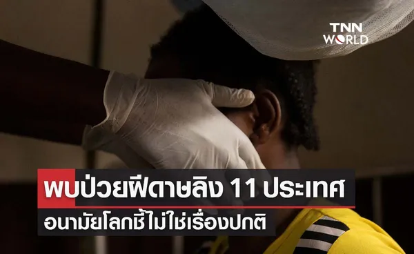 WHO พบป่วยฝีดาษลิงราว 80 รายใน 11 ประเทศ ชี้ไม่ใช่เรื่องปกติ 