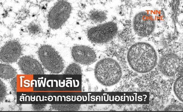 โรคฝีดาษลิง ลักษณะอาการของโรคเป็นอย่างไร? พร้อมแนะวิธีป้องกัน