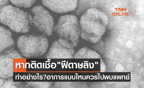 หากติดเชื้อ ฝีดาษลิง ควรทำอย่างไร? อาการแบบไหนควรไปพบแพทย์