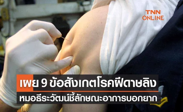 หมอธีระวัฒน์ เผยข้อสังเกต “ฝีดาษลิง” 9 ข้อ ลักษณะโรคบอกยาก