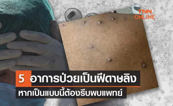 5 อาการเข้าข่ายเสี่ยงป่วย ‘โรคฝีดาษลิง’ หากเป็นแบบนี้รีบพบแพทย์