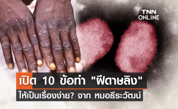 ฝีดาษลิง หมอธีระวัฒน์ เผย 10 ข้อทำโรคนี้ให้เป็นเรื่องง่าย?