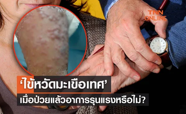 ‘ไข้หวัดมะเขือเทศ’ รุนแรงหรือไม่? อาการแรกเริ่มเป็นอย่างไร