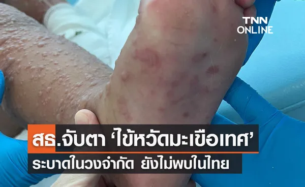 สธ.จับตา ไข้หวัดมะเขือเทศ อาการคล้าย มือเท้าปาก ในเด็ก ไม่ใช่โรคชนิดใหม่