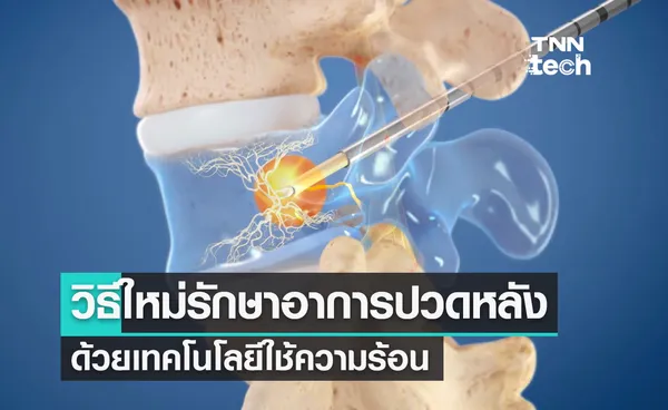 อินทราเซปต์ (Intracept) วิธีการใหม่รักษาอาการปวดหลังด้วยเทคโนโลยีใช้ความร้อน