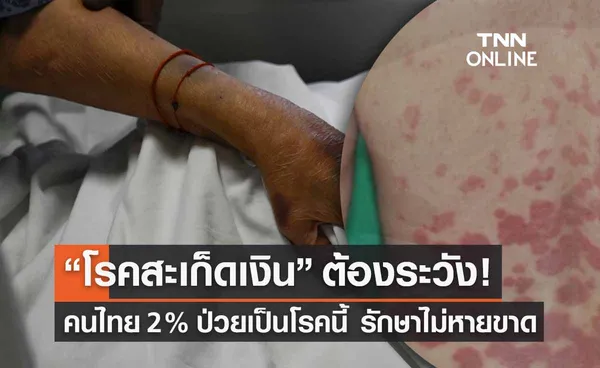 “โรคสะเก็ดเงิน” ต้องระวัง! 2% ประชากรไทยป่วยเป็นโรคนี้ 