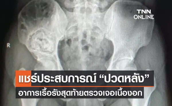 หนุ่มแชร์ประสบการณ์นึกว่า“ปวดหลัง”ที่แท้เป็นเนื้องอกในเชิงกราน