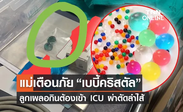 แม่เตือนภัย “เบบี้คริสตัล” ลูกน้อยเผลอกินอุดตันลำไส้ต้องเข้า ICU