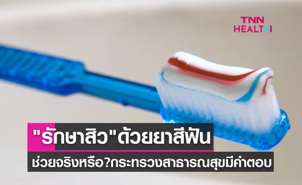 รักษาสิว ด้วยยาสีฟัน ช่วยได้จริงหรือ? กระทรวงสาธารณสุข มีคำตอบ
