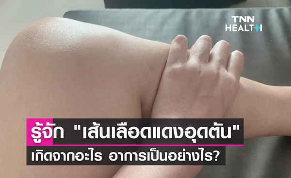 รู้จัก เส้นเลือดแดงอุดตัน เกิดจากอะไร อาการเป็นอย่างไร? 