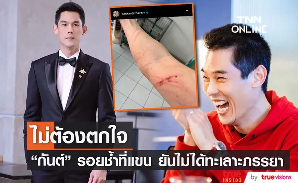 ไม่ต้องตกใจ กันต์ กันตถาวร ภาพรอยช้ำที่แขน ยันไม่ได้ทะเลาะกับเมีย