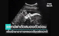 ครั้งแรก ! แพทย์ผ่าตัดสมองตัวอ่อนในครรภ์รักษาอาการหลอดเลือดผิดปกติ