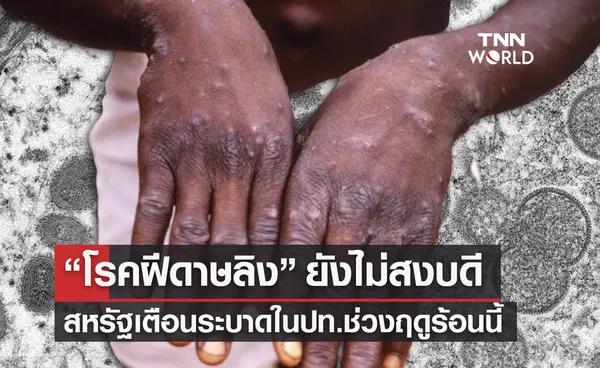 “โรคฝีดาษลิง” ยังไม่สงบดี สหรัฐเตือนระวังระบาดในปท.ช่วงฤดูร้อนนี้