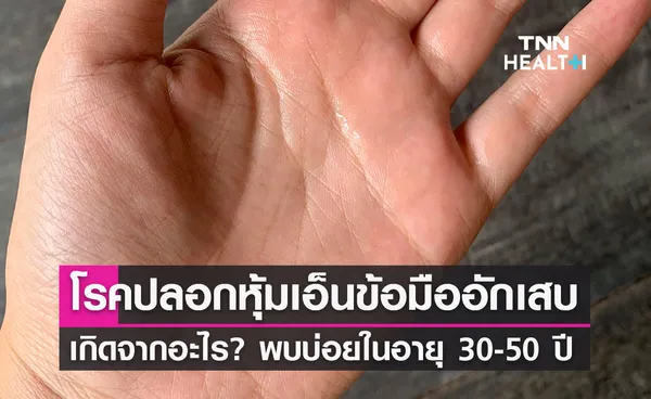 โรคปลอกหุ้มเอ็นข้อมืออักเสบ เกิดจากอะไร? พบบ่อยในผู้ป่วยอายุ 30-50 ปี