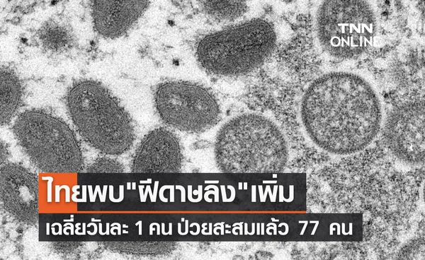 ไทยพบฝีดาษลิงเพิ่ม เฉลี่ยวันละ 1 คน ป่วยสะสมแล้ว 77 คน 