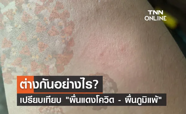 ผื่นแดงโควิด - ผื่นภูมิแพ้ ต่างกันอย่างไร?