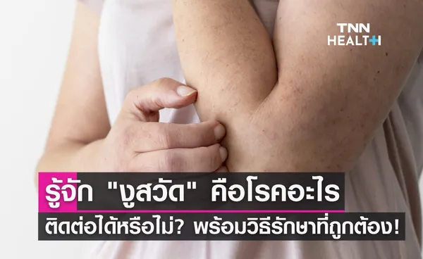 ทำความรู้จัก โรคงูสวัด คืออะไร ติดต่อได้หรือไม่? พร้อมวิธีดูแลรักษาที่ถูกต้อง!