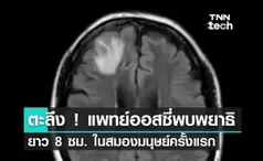 ตะลึง ! แพทย์ออสซี่พบพยาธิยาว 8 ซม. ในสมองมนุษย์ครั้งแรกของโลก